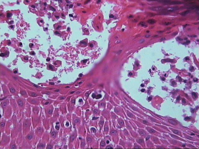 Fig.11 Microabscesos de Pautrier - <div style=